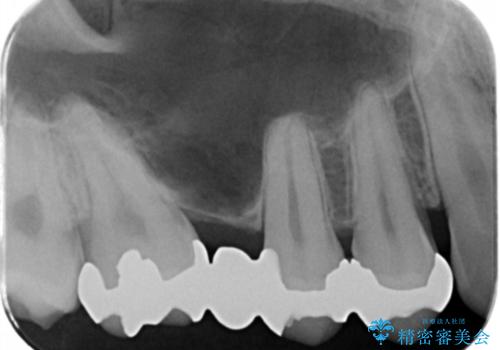 銀の詰め物を白くしたい。の治療前