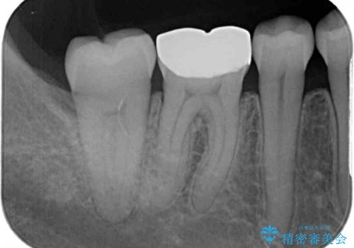 口を開けたときに目立つ銀歯 オールセラミック治療の治療前