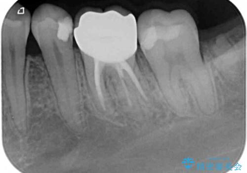処置を先延ばしにしていたむし歯 奥歯のセラミック治療の治療後