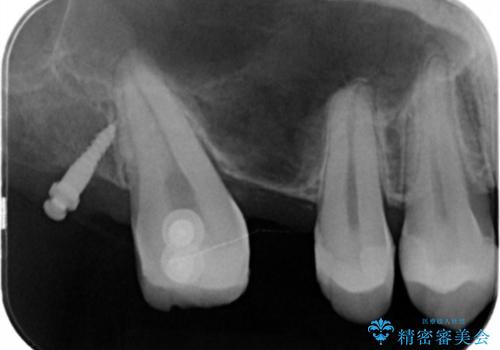 銀の詰め物を白くしたい。の治療中