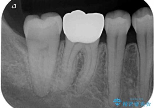 口を開けたときに目立つ銀歯 オールセラミック治療の治療後