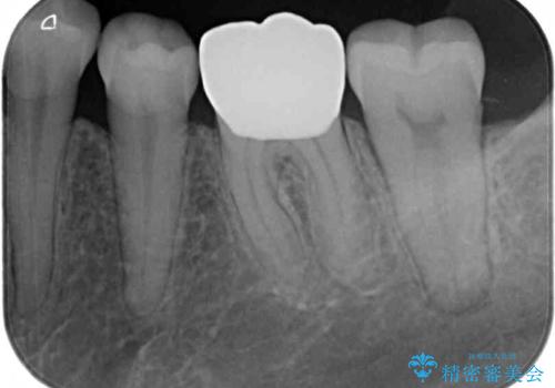 口を開けたときに目立つ銀歯 オールセラミック治療の治療後