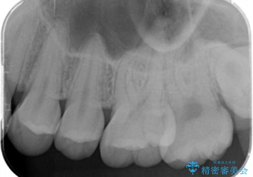 奥歯の黒いのが気になる。の治療前