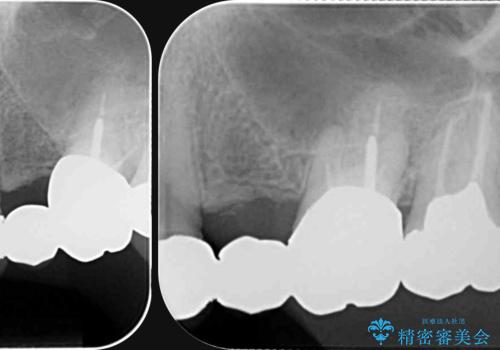 銀歯の見た目を改善、ジルコニア製セラミックブリッジの治療前