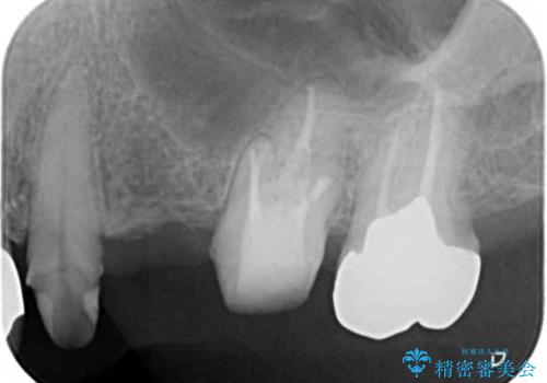 銀歯の見た目を改善、ジルコニア製セラミックブリッジの治療中