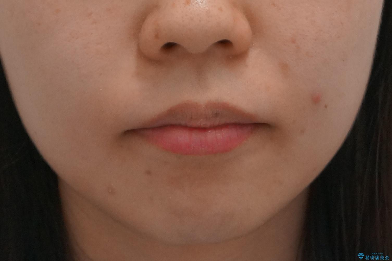 奥歯のかみ合わせも妥協しない インビザライン治療の治療前(顔貌)