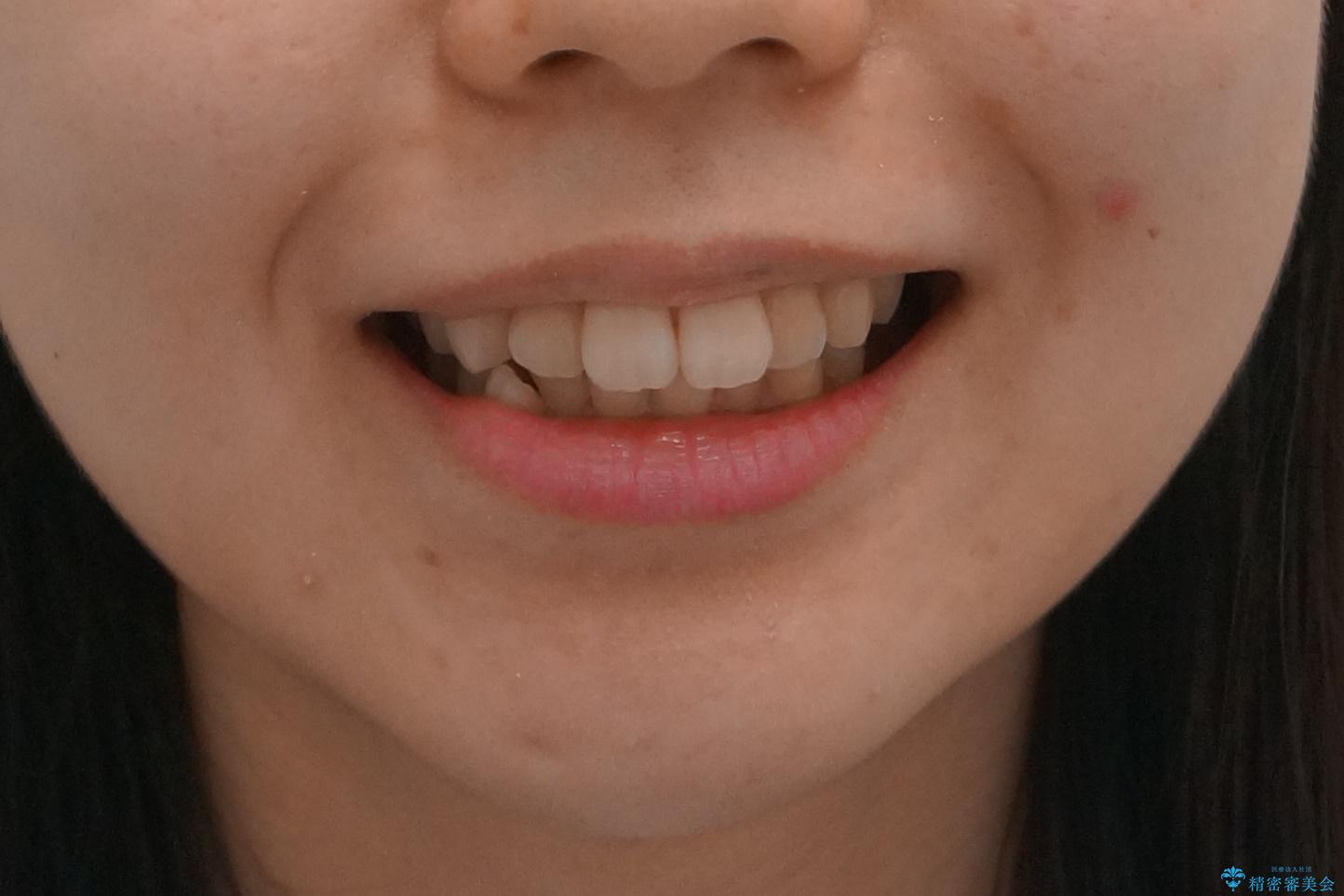 奥歯のかみ合わせも妥協しない　インビザライン治療の治療前（顔貌）
