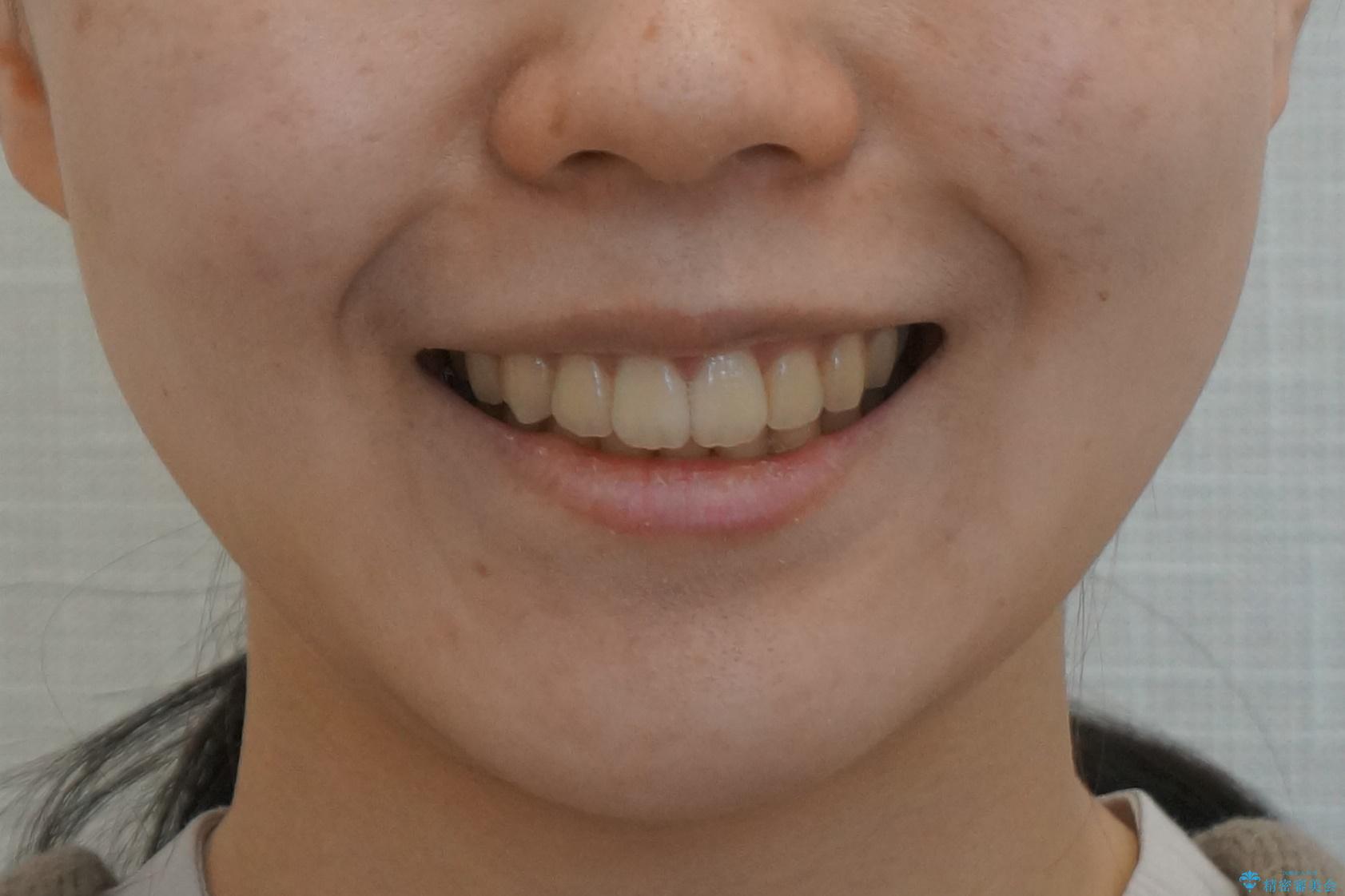 奥歯のかみ合わせも妥協しない　インビザライン治療の治療後（顔貌）