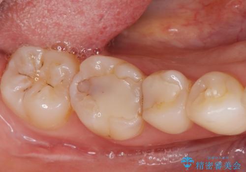 劣化した保険の詰め物部分の治療をしたい。