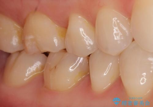 劣化した保険の詰め物部分の治療をしたい。の治療前