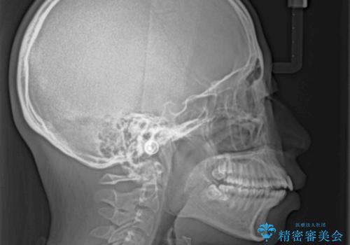 口が閉じられない 抜歯矯正で横顔の印象が劇的に変化の治療前