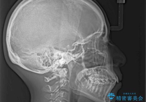 閉じにくい唇 抜歯矯正でスッキリした横顔にの治療前