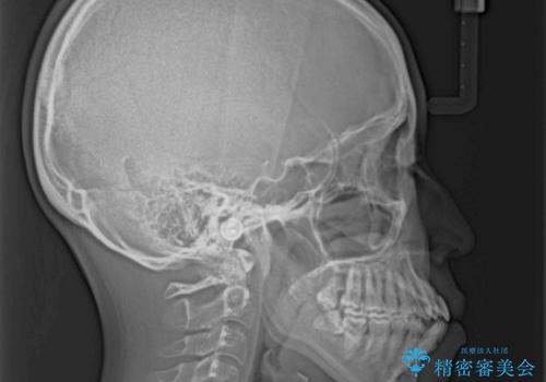 膨らんだ口元をスッキリと ワイヤー装置での抜歯矯正の治療前