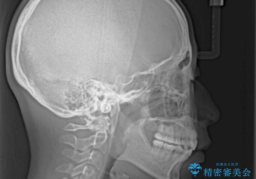 口が閉じられない 抜歯矯正で横顔の印象が劇的に変化の治療後