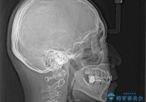 【モニター】前歯の突出感を抜歯矯正で改善の治療後