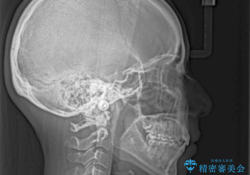 閉じにくい唇 抜歯矯正でスッキリした横顔にの治療後
