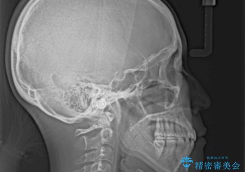 膨らんだ口元をスッキリと ワイヤー装置での抜歯矯正の治療後