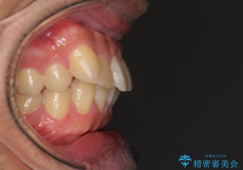 遠方からの通院 インビザライン矯正治療の治療前