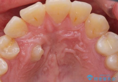 親知らず・埋伏歯の抜歯の症例 治療前