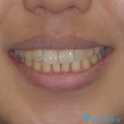 前に出ている前歯を引っ込めたい インビザライン矯正の治療後(顔貌)