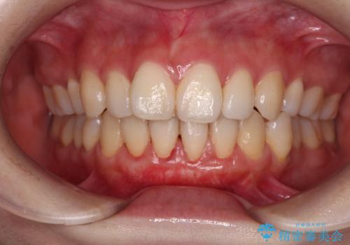 長く見えてしまう下顎前歯 歯肉移植術で露出した歯根を覆い隠すの治療後