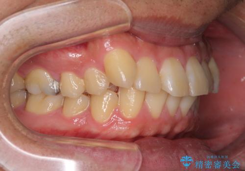 遠方からの通院 インビザライン矯正治療の治療前