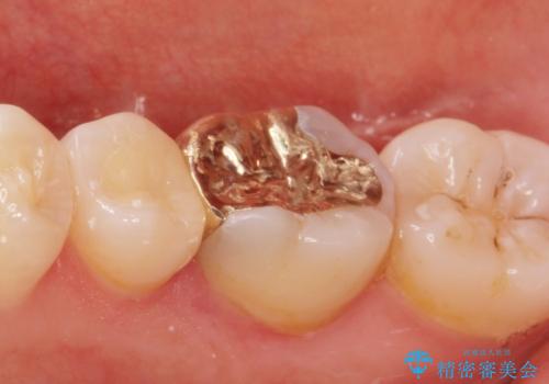 劣化した保険の詰め物部分の治療をしたい。の治療後