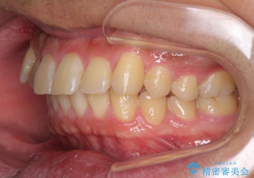 遠方からの通院 インビザライン矯正治療の治療前