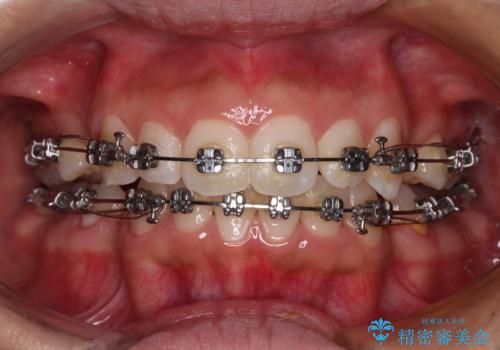 閉じにくい唇 抜歯矯正でスッキリした横顔にの治療中
