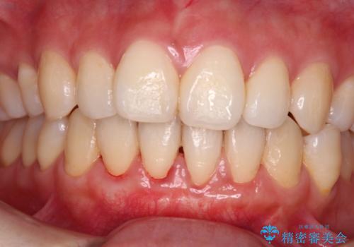 長く見えてしまう下顎前歯 歯肉移植術で露出した歯根を覆い隠すの治療後