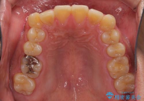 遠方からの通院 インビザライン矯正治療の治療前