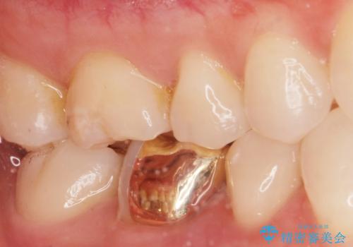 劣化した保険の詰め物部分の治療をしたい。の治療後
