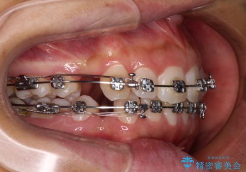 閉じにくい唇 抜歯矯正でスッキリした横顔にの治療中