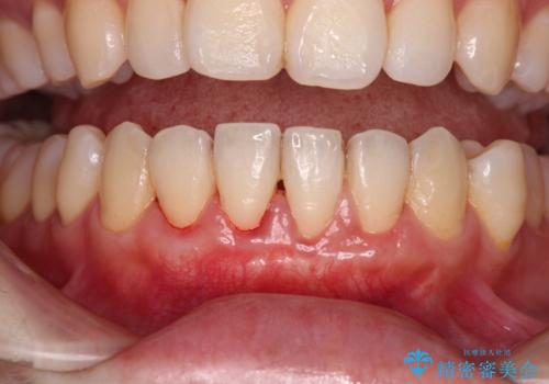 長く見えてしまう下顎前歯　歯肉移植術で露出した歯根を覆い隠すの治療後