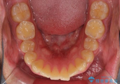 遠方からの通院 インビザライン矯正治療の治療前