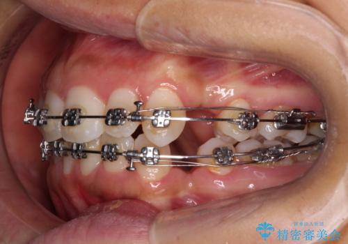 閉じにくい唇 抜歯矯正でスッキリした横顔にの治療中