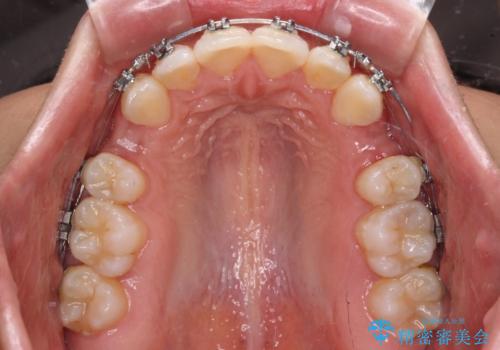閉じにくい唇 抜歯矯正でスッキリした横顔にの治療中