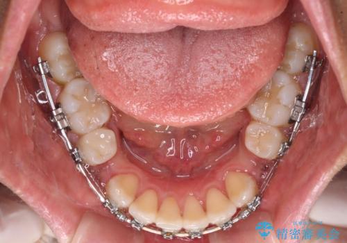 閉じにくい唇 抜歯矯正でスッキリした横顔にの治療中