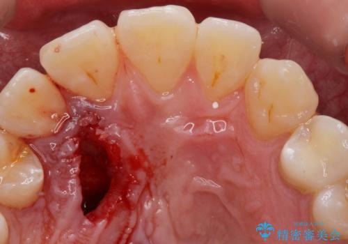 上顎の内側に歯が生えていて気になる。(静脈内鎮静下での抜歯)の治療中