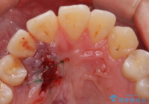 親知らず・埋伏歯の抜歯の症例 治療後