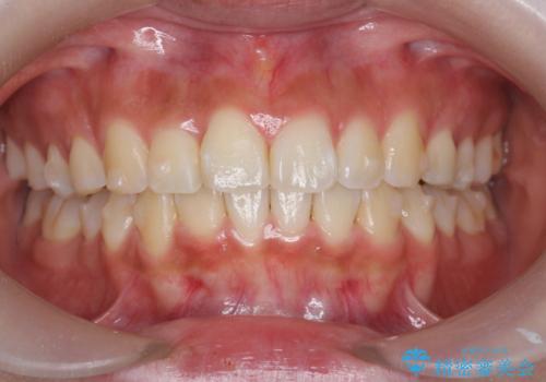 ワイヤーの小矯正を行い、治療期間を短縮するマウスピース治療の治療中