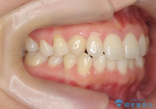 [前歯のねじれ・がたつきを治したい ]ワイヤーとマウスピースの併用矯正治療の治療前