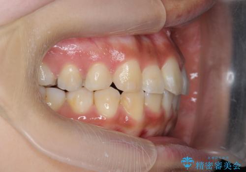 ワイヤーの小矯正を行い、治療期間を短縮するマウスピース治療の治療中