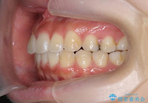 ワイヤーの小矯正を行い、治療期間を短縮するマウスピース治療の治療中