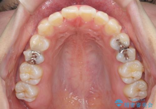 ワイヤーの小矯正を行い、治療期間を短縮するマウスピース治療の治療中