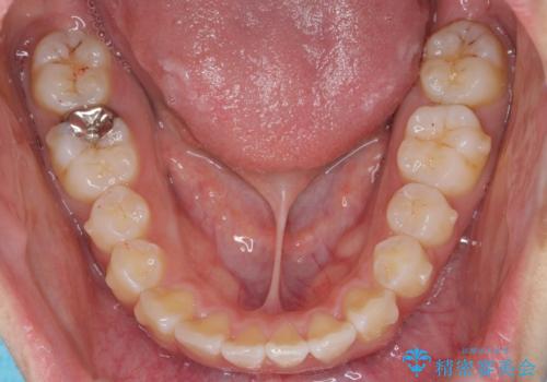 ワイヤーの小矯正を行い、治療期間を短縮するマウスピース治療の治療中