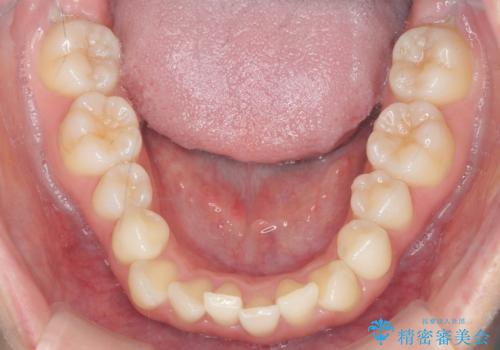 [前歯のねじれ・がたつきを治したい ]ワイヤーとマウスピースの併用矯正治療の治療前