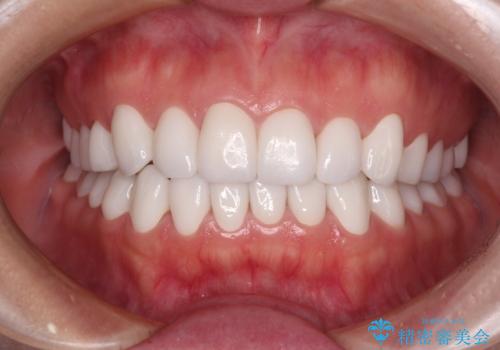 変色している歯をとにかく白く　全顎セラミック治療の症例 治療後