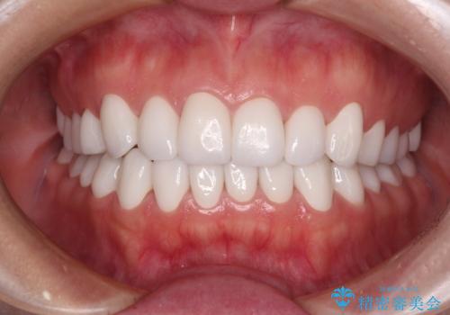 変色している歯をとにかく白く 全顎セラミック治療