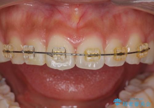 ワイヤーの小矯正を行い、治療期間を短縮するマウスピース治療の治療中